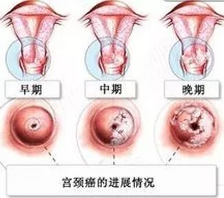 杭州市临安区HPV宫颈癌疫苗接种点地址及预约咨询电话